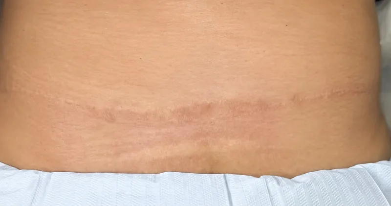 Abdômen com cicatriz horizontal, depois