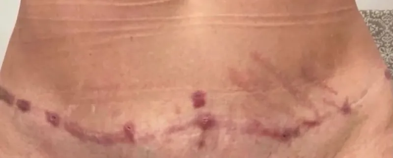 Abdômen com cicatriz marcada, antes