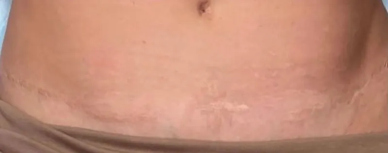 Abdômen com cicatriz marcada, depois