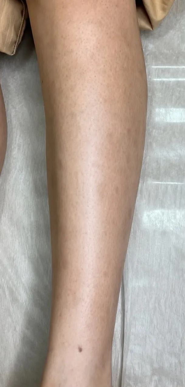 Perna com manchas, depois